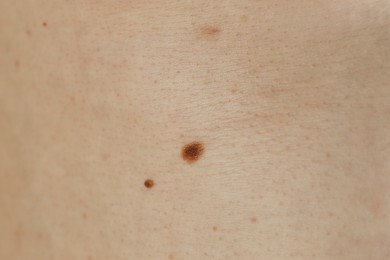 Photo of Man with birthmarks on his skin, closeup