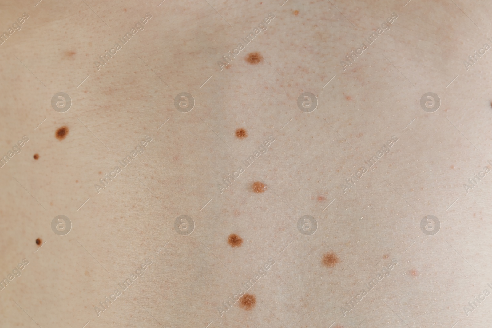 Photo of Man with birthmarks on his skin, closeup