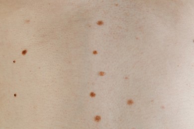 Man with birthmarks on his skin, closeup