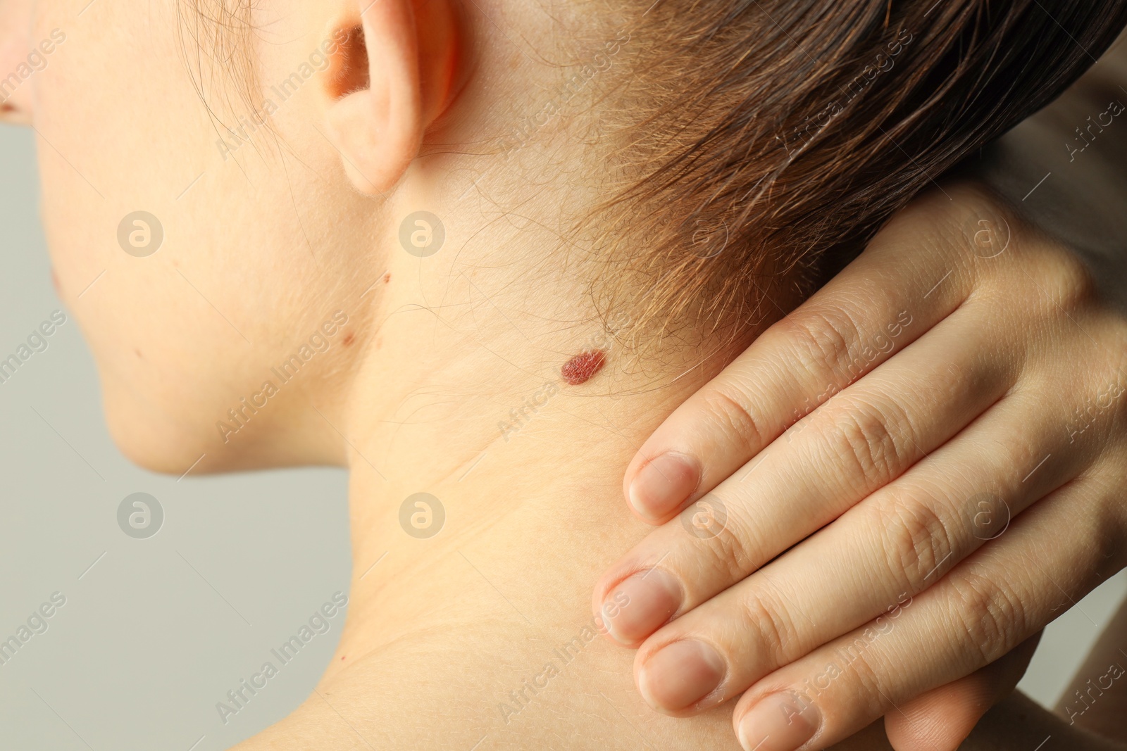 Photo of Woman with moles on her skin against light grey background, closeup