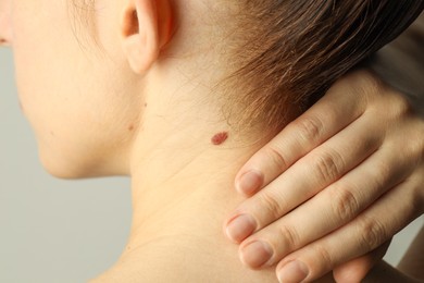 Woman with moles on her skin against light grey background, closeup