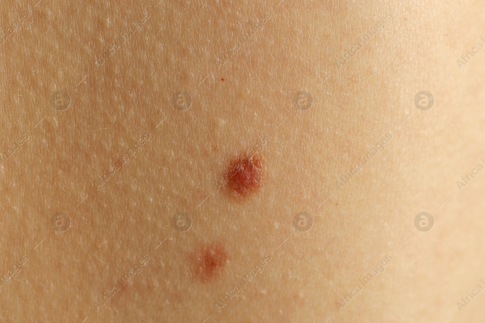 Photo of Woman with moles on her skin, closeup