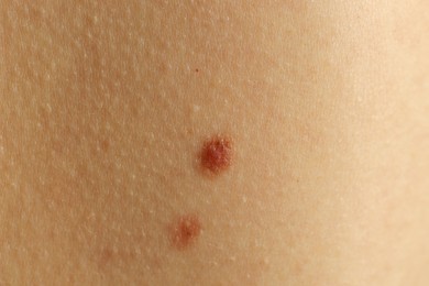 Woman with moles on her skin, closeup