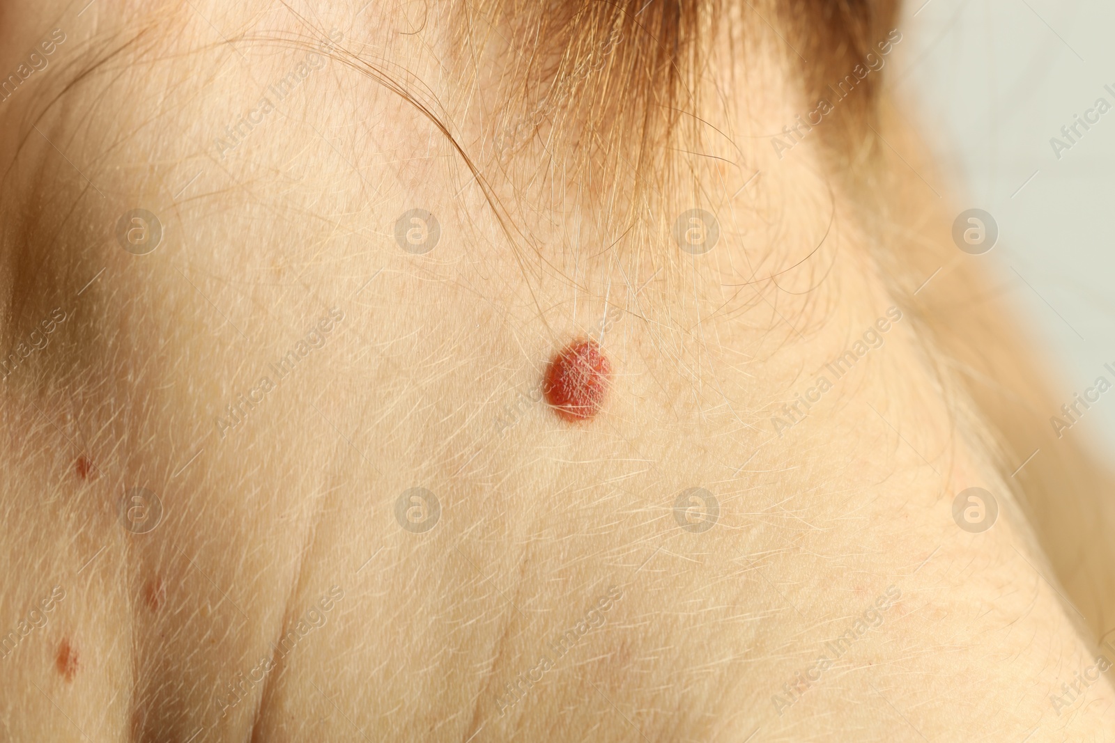 Photo of Woman with mole on her skin, closeup