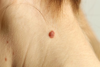 Photo of Woman with mole on her skin, closeup