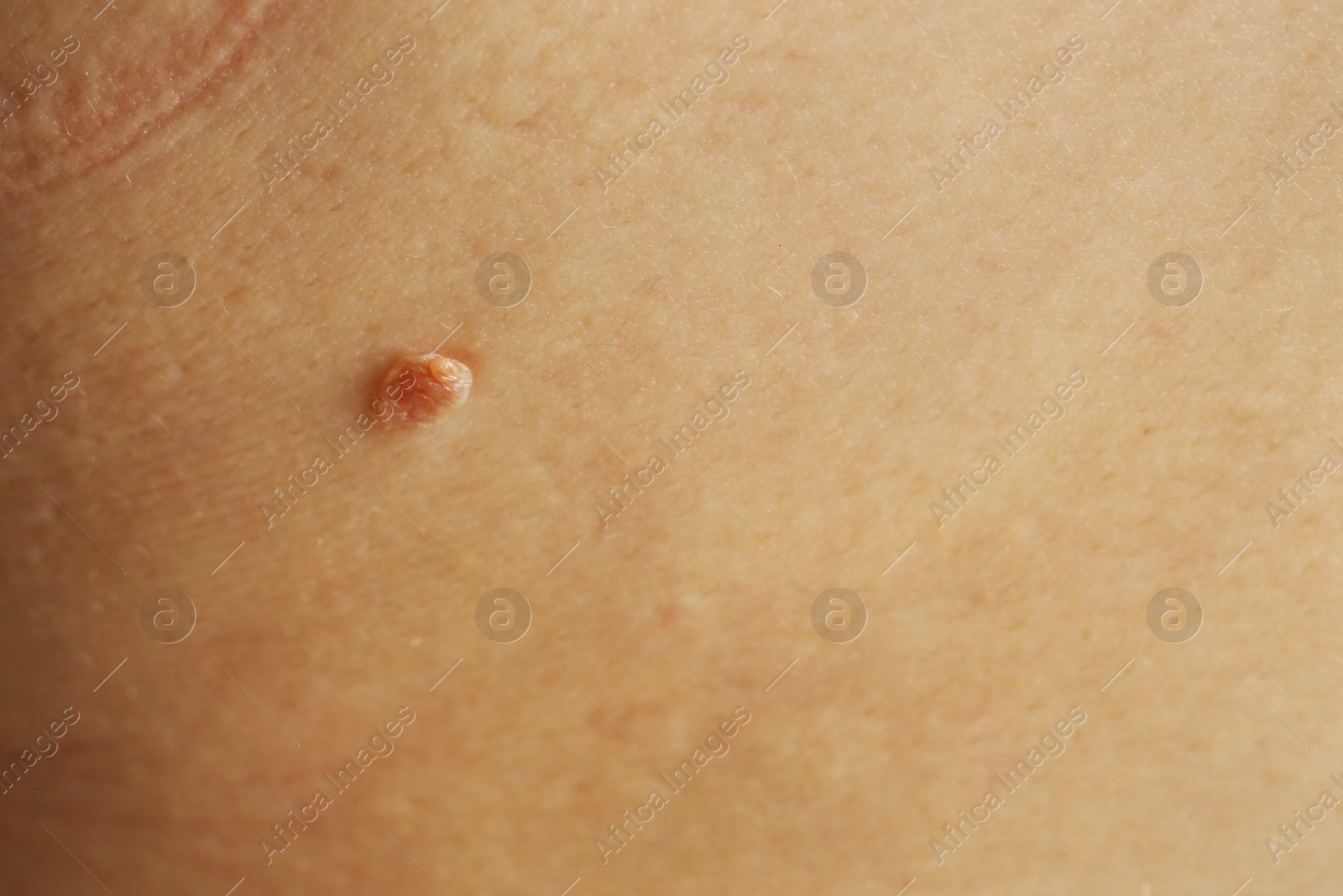 Photo of Woman with mole on her skin, closeup