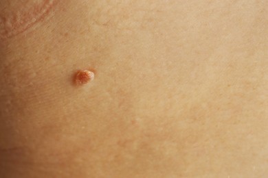 Photo of Woman with mole on her skin, closeup