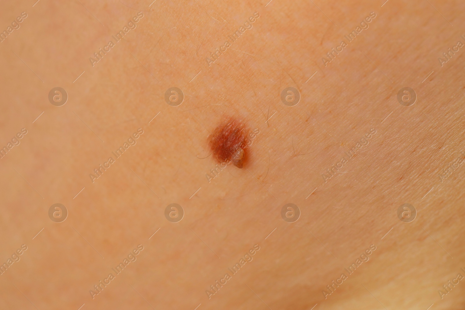 Photo of Woman with mole on her skin, closeup