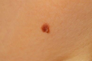 Woman with mole on her skin, closeup