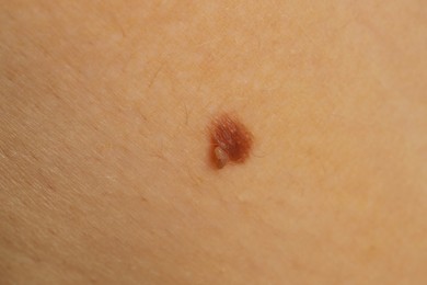 Photo of Woman with mole on her skin, closeup