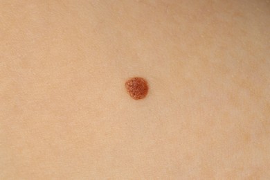 Photo of Woman with mole on her skin, closeup