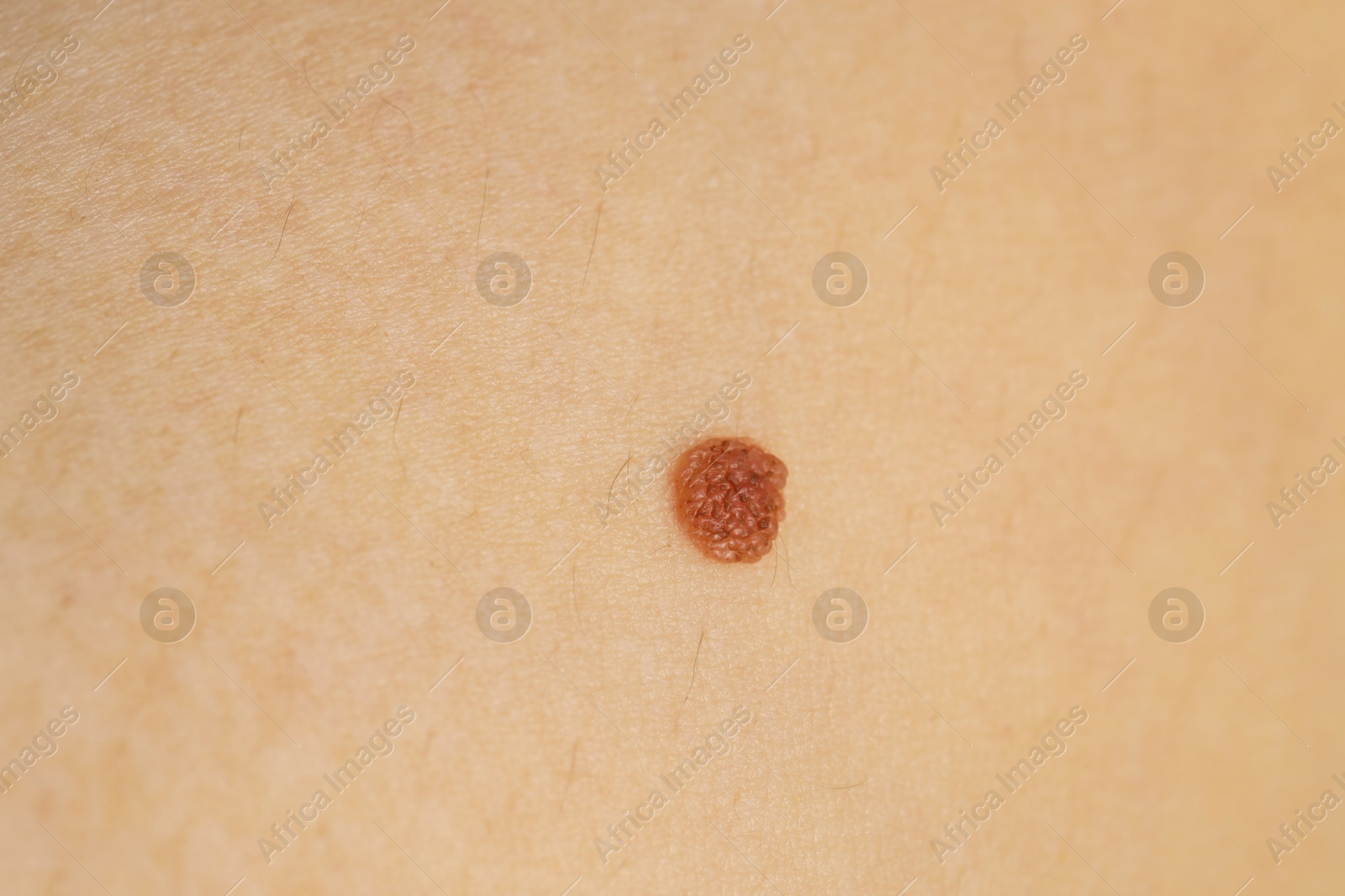 Photo of Woman with mole on her skin, closeup