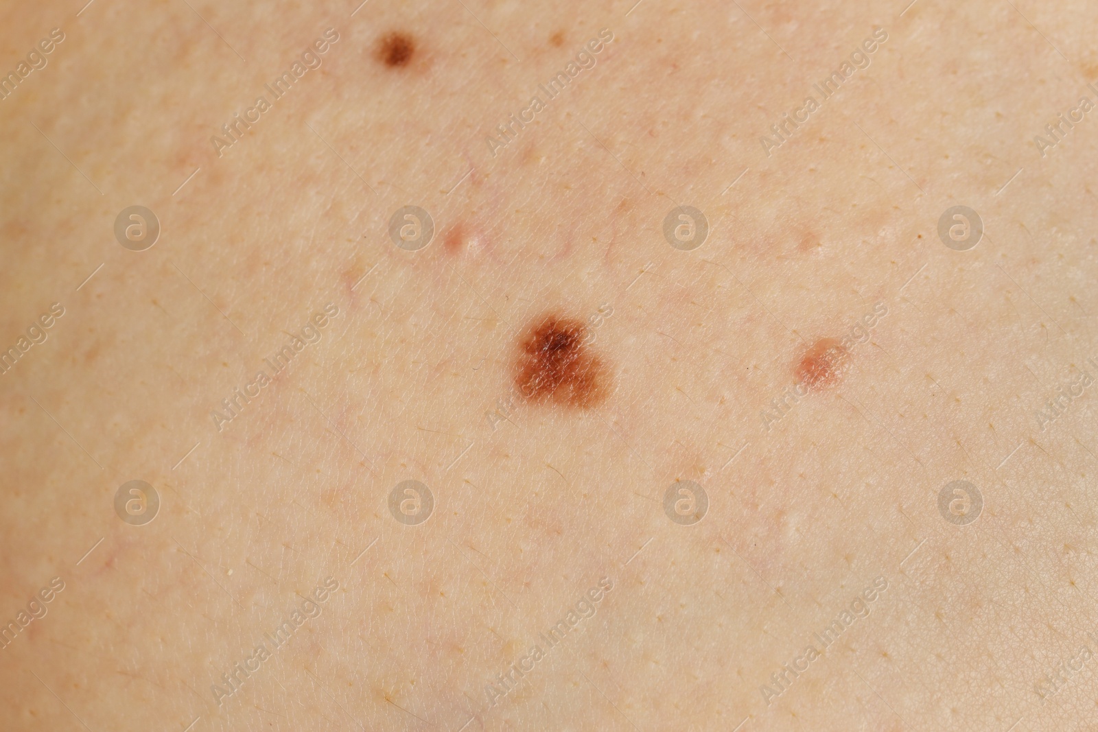 Photo of Woman with birthmark on her skin, closeup