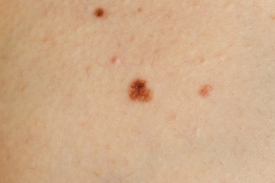 Photo of Woman with birthmark on her skin, closeup