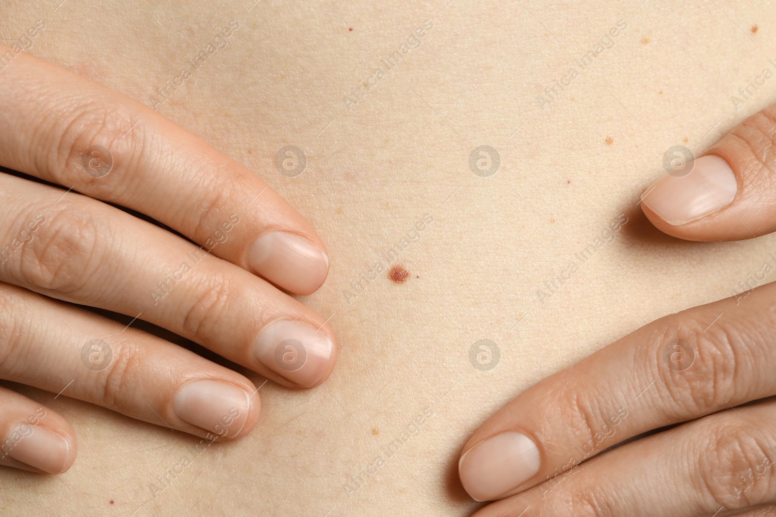 Photo of Woman with mole on her skin, closeup