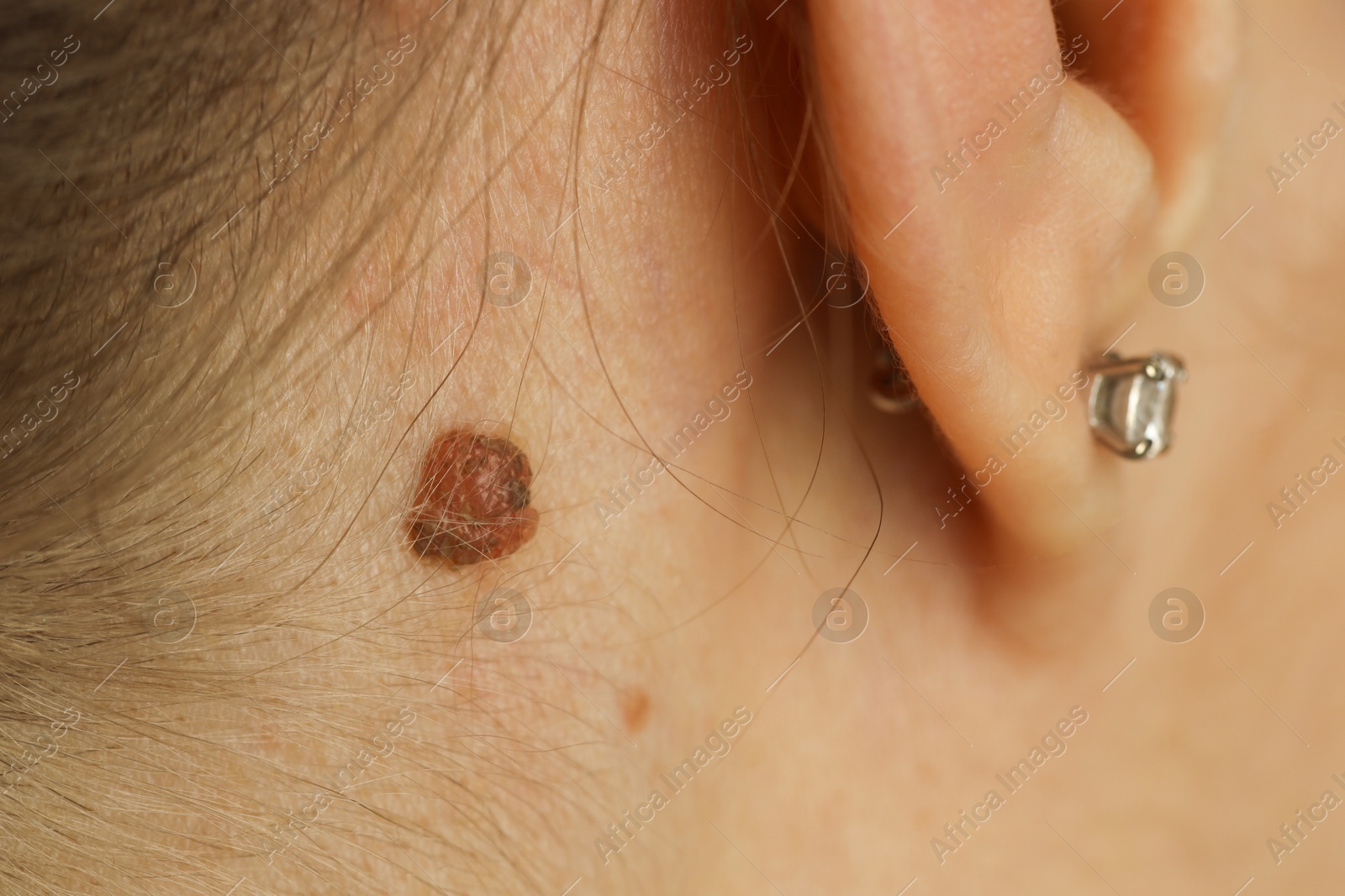 Photo of Woman with mole on her skin, closeup