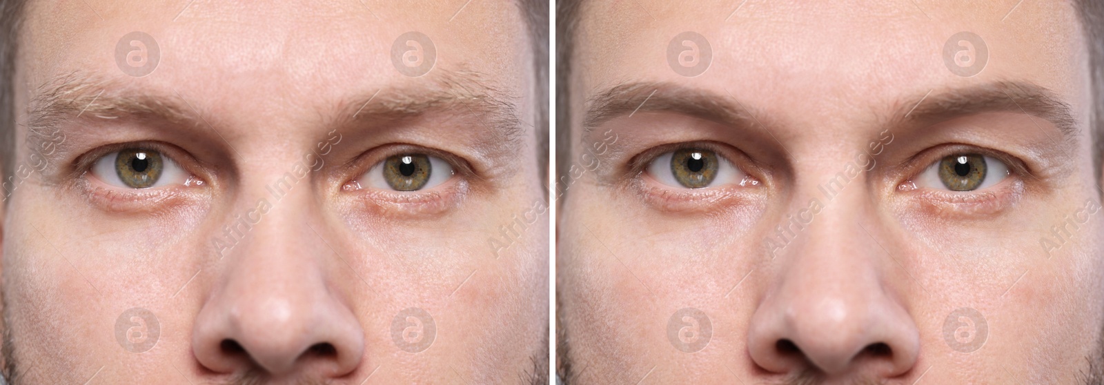 Image of Man before and after permanent eyebrow procedure, collage with closeup photos