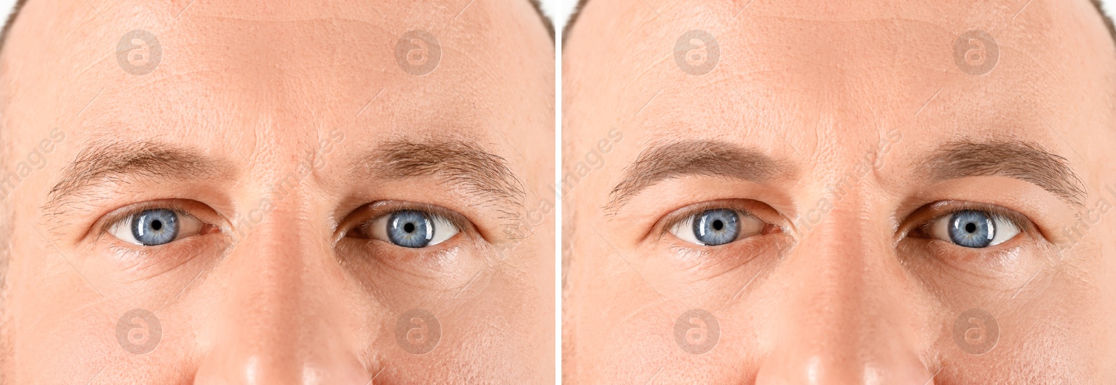 Image of Man before and after permanent eyebrow procedure, collage with closeup photos