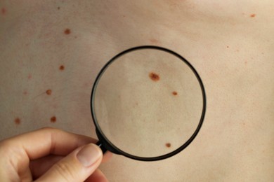 Dermatologist examining patient's birthmarks with magnifying glass, closeup