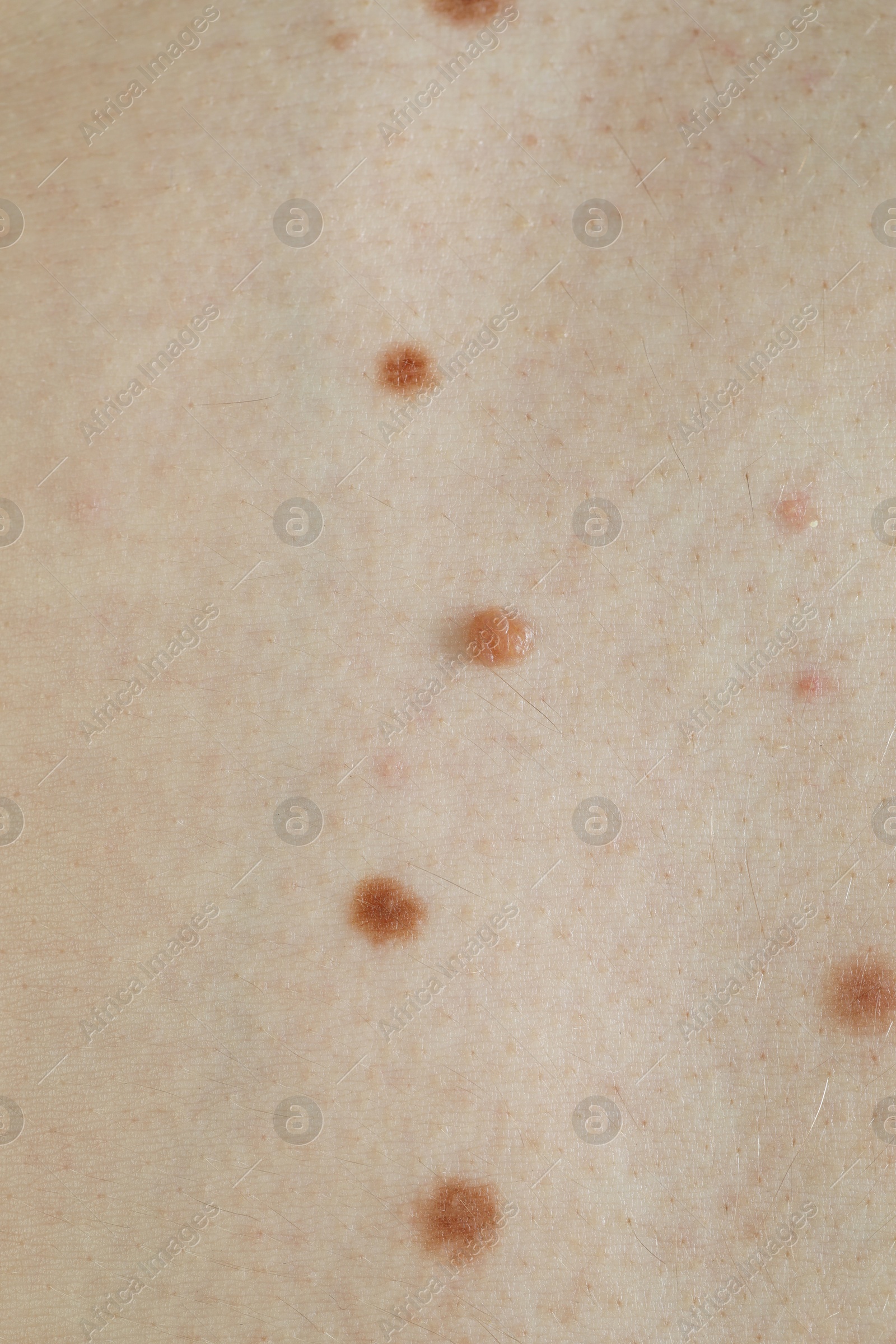 Photo of Man with birthmarks on his skin, closeup