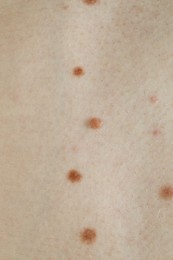 Photo of Man with birthmarks on his skin, closeup