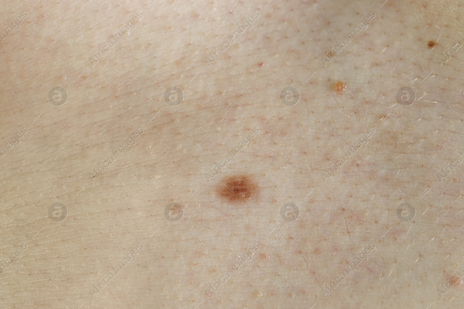 Photo of Man with birthmark on his skin, closeup