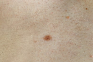 Photo of Man with birthmark on his skin, closeup