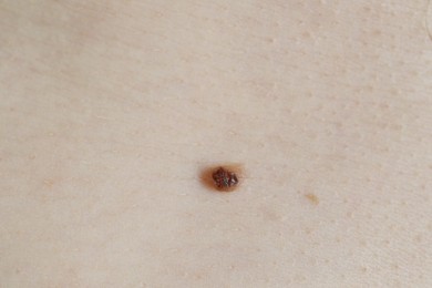 Photo of Man with birthmark on his skin, closeup