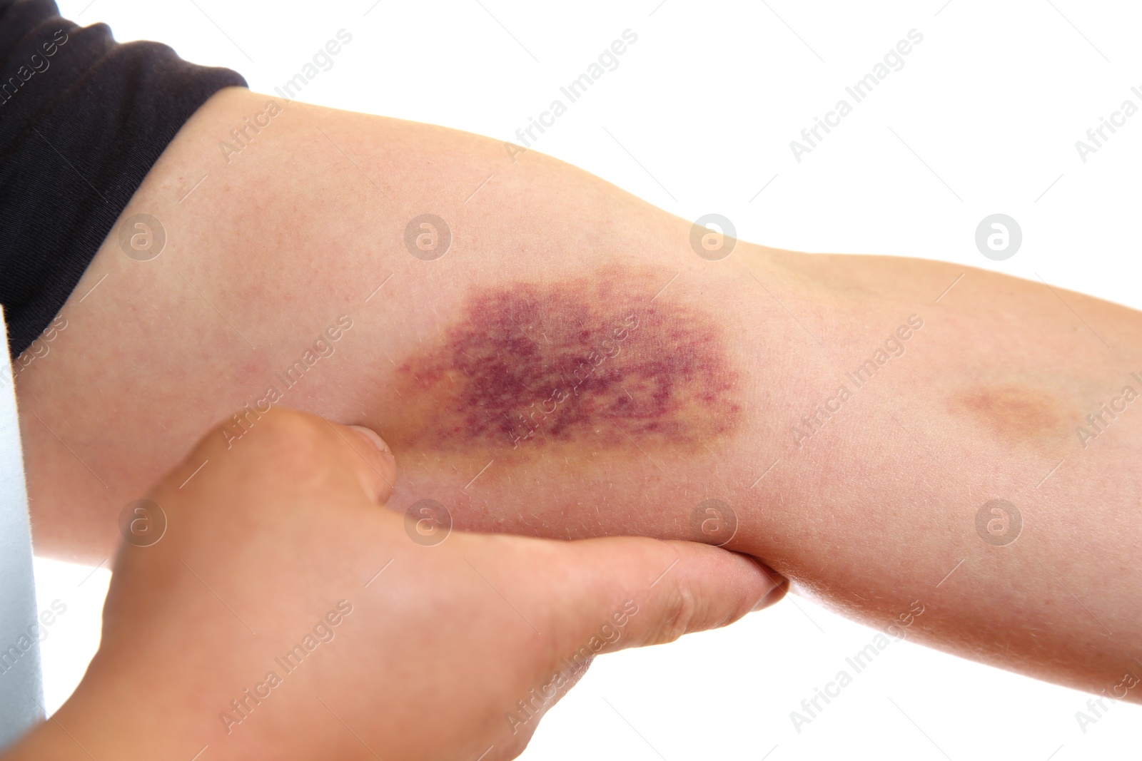 Photo of Woman with bruise on arm against white background, closeup