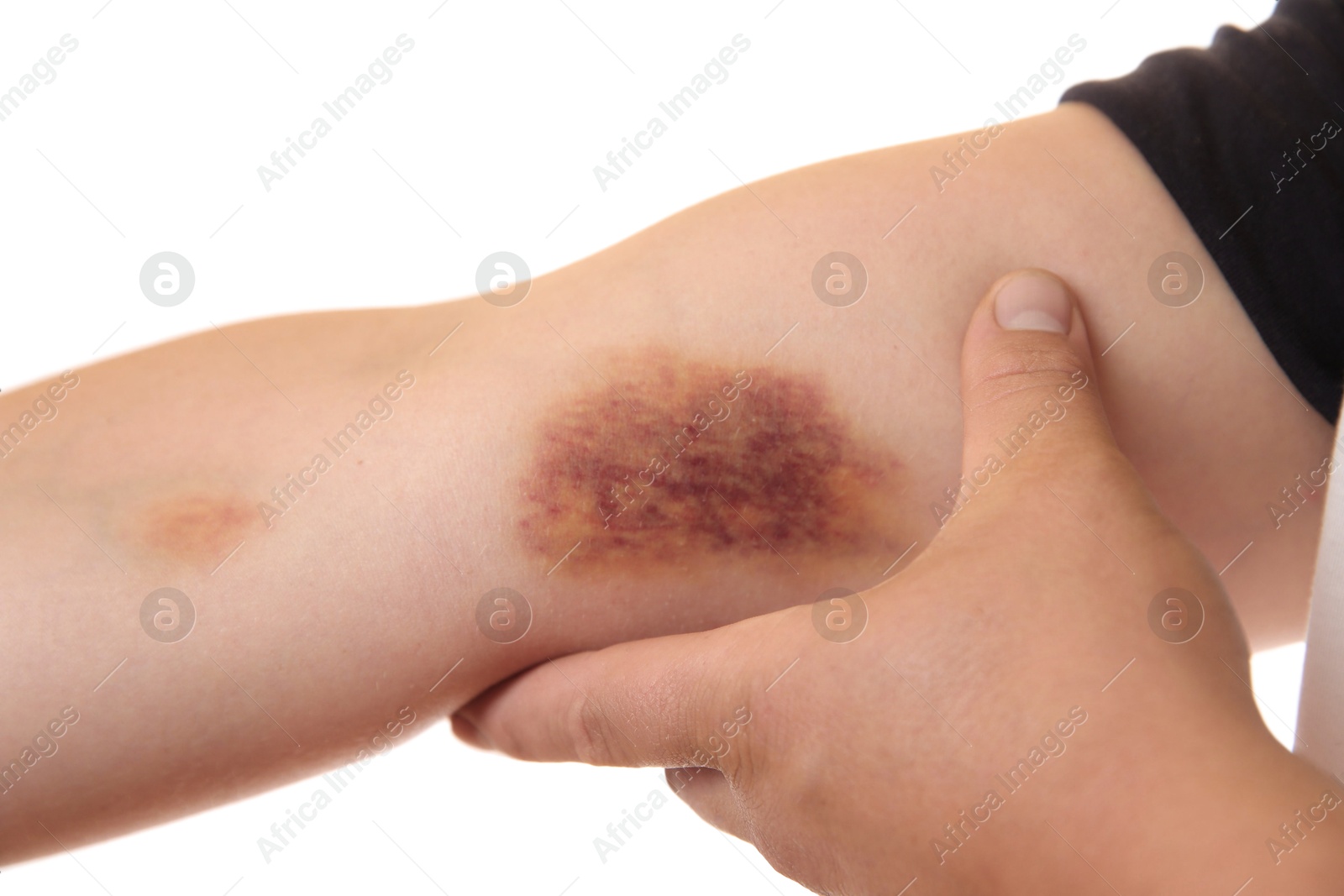 Photo of Woman with bruise on arm against white background, closeup