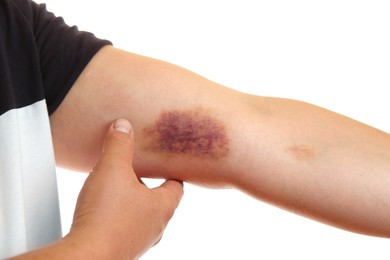 Photo of Woman with bruise on arm against white background, closeup