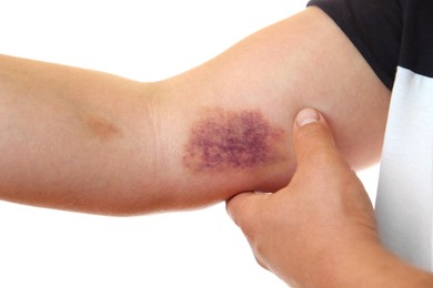 Photo of Woman with bruise on arm against white background, closeup