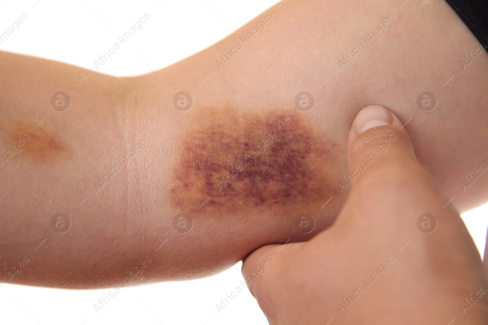 Photo of Woman with bruise on arm against white background, closeup