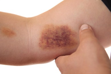 Photo of Woman with bruise on arm against white background, closeup