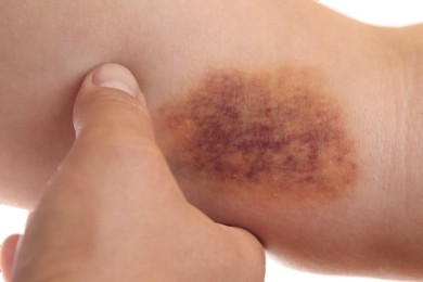 Photo of Woman with bruise on arm against white background, closeup