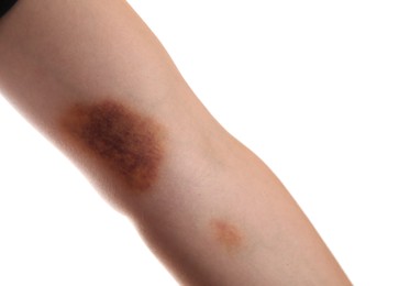 Photo of Woman with bruise on arm against white background, closeup