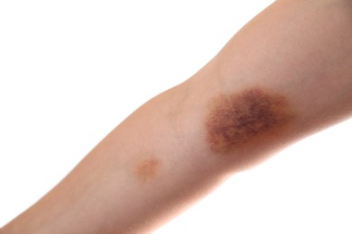 Photo of Woman with bruise on arm against white background, closeup