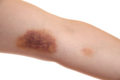 Photo of Woman with bruise on arm against white background, closeup