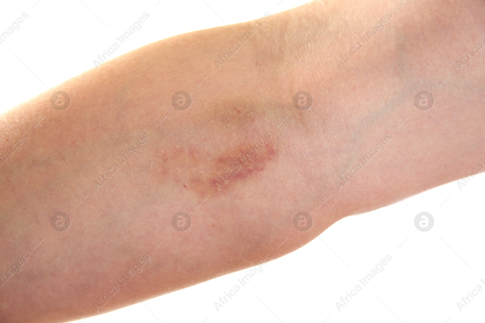 Photo of Woman with bruise on arm against white background, closeup