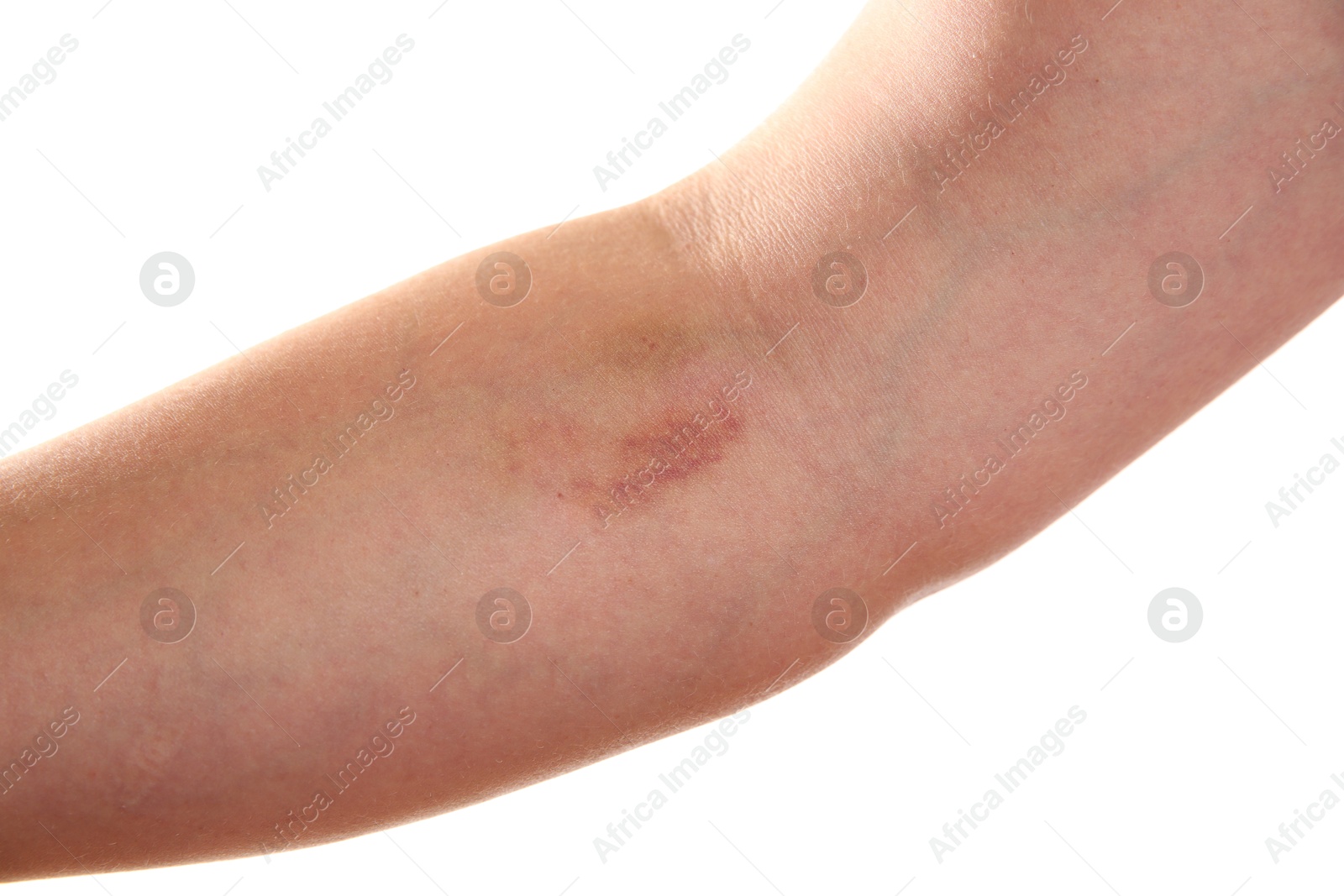 Photo of Woman with bruise on arm against white background, closeup