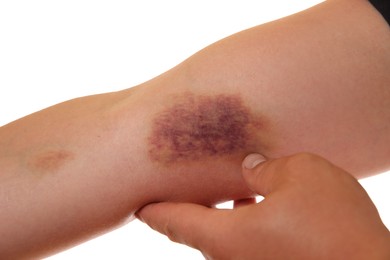 Photo of Woman with bruise on arm against white background, closeup