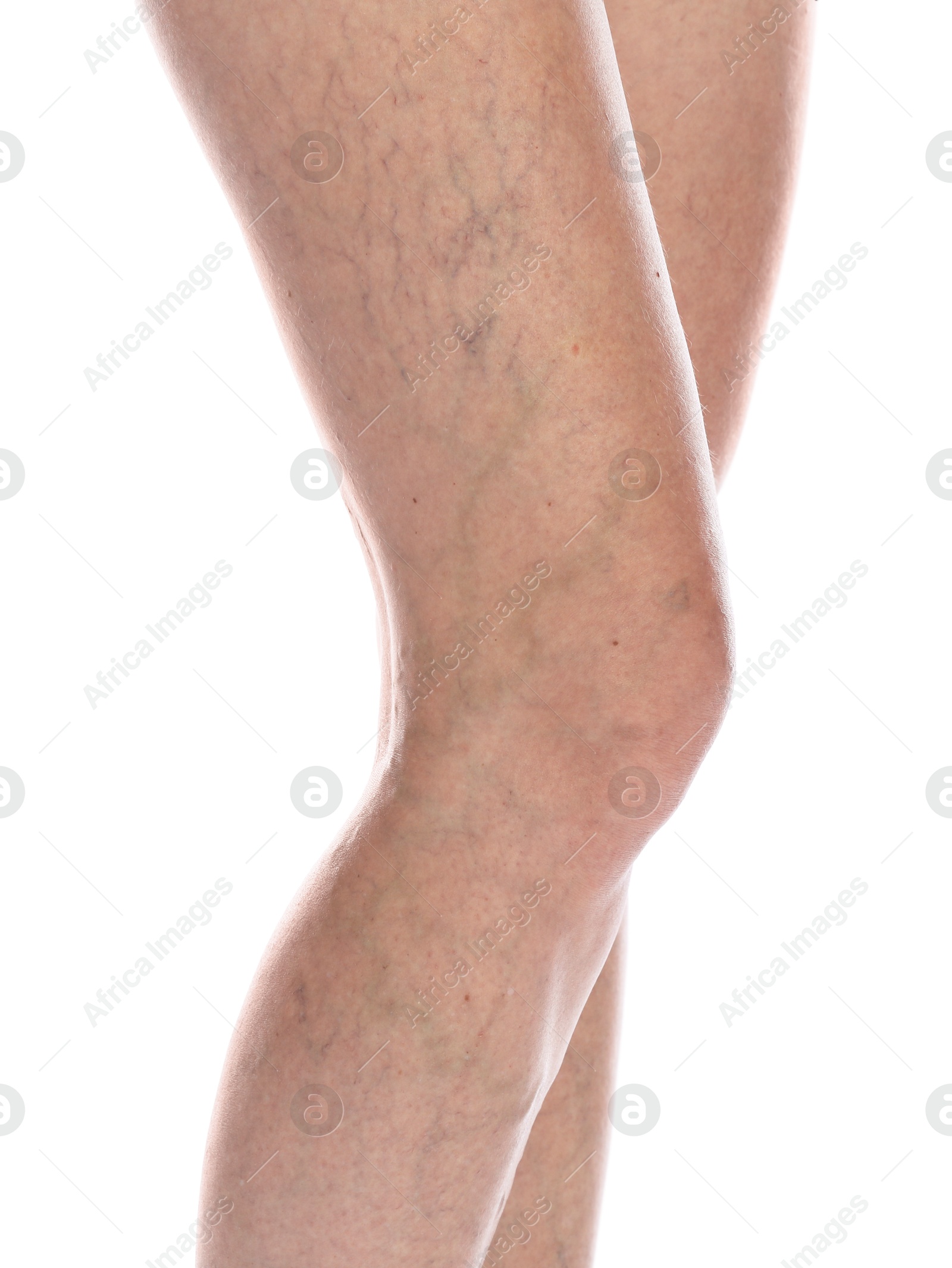 Photo of Woman with varicose veins on white background, closeup