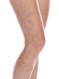 Woman with varicose veins on white background, closeup