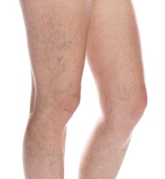 Woman with varicose veins on white background, closeup