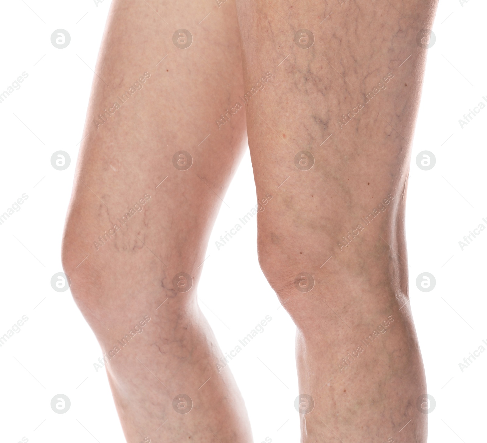 Photo of Woman with varicose veins on white background, closeup