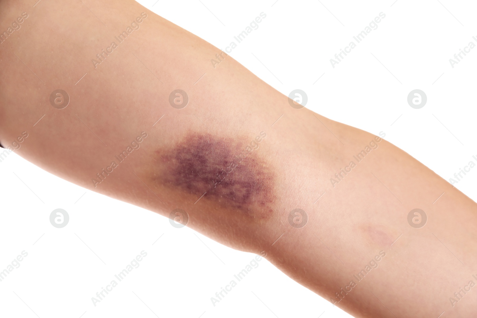 Photo of Woman with bruise on arm against white background, closeup