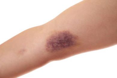 Photo of Woman with bruise on arm against white background, closeup