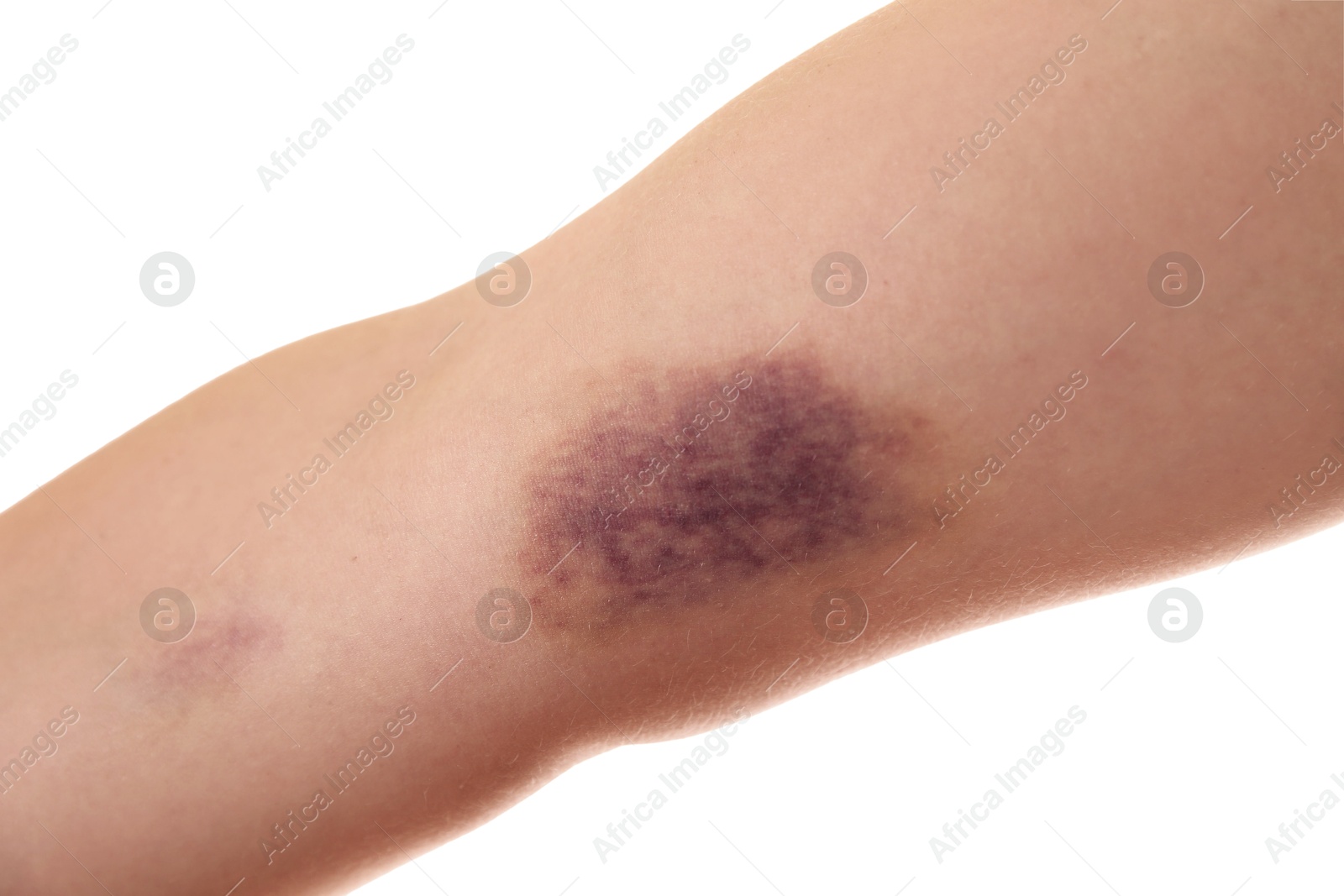 Photo of Woman with bruise on arm against white background, closeup