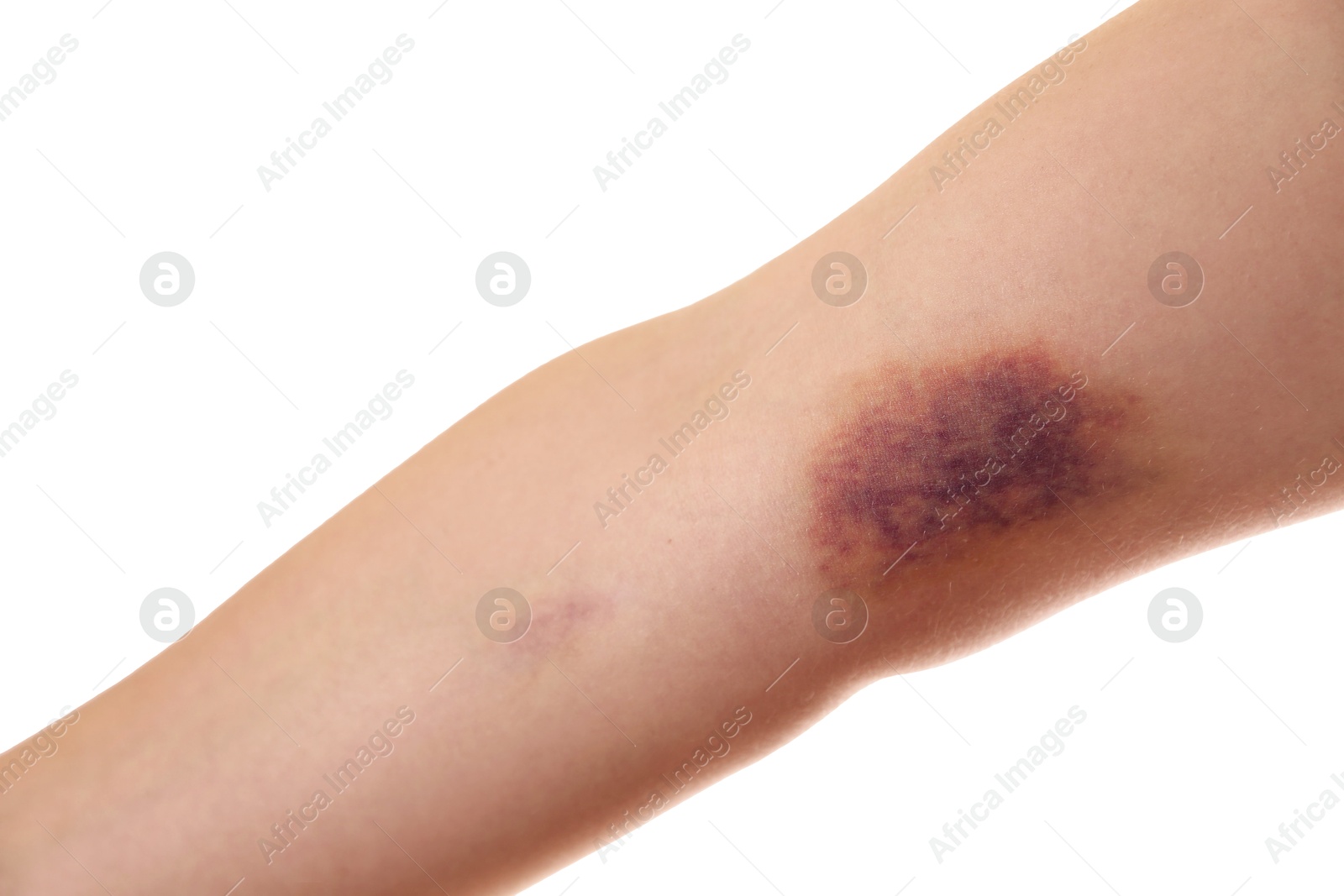 Photo of Woman with bruise on arm against white background, closeup