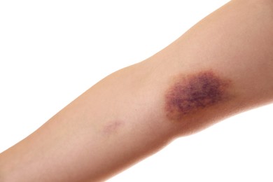 Photo of Woman with bruise on arm against white background, closeup